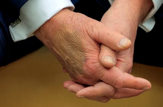 La Casa Blanca explicó que se trata de una irritación leve asociada a apretones de mano y al uso de aspirina.