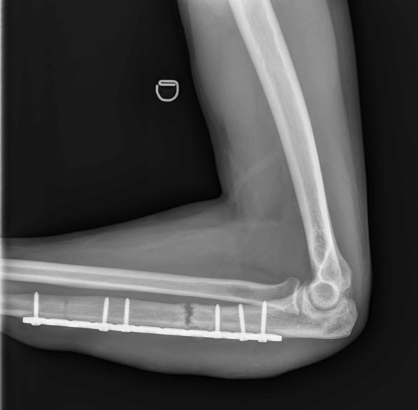 Josué Valverde lleva ocho meses de vivir con una fractura de clavícula y nada que le dan cita para la operación