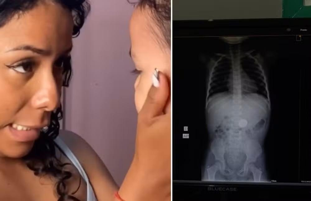 Una confesión inesperada de una niña de 3 años llevó a su familia al hospital. La radiografía confirmó que había ingerido una moneda.
