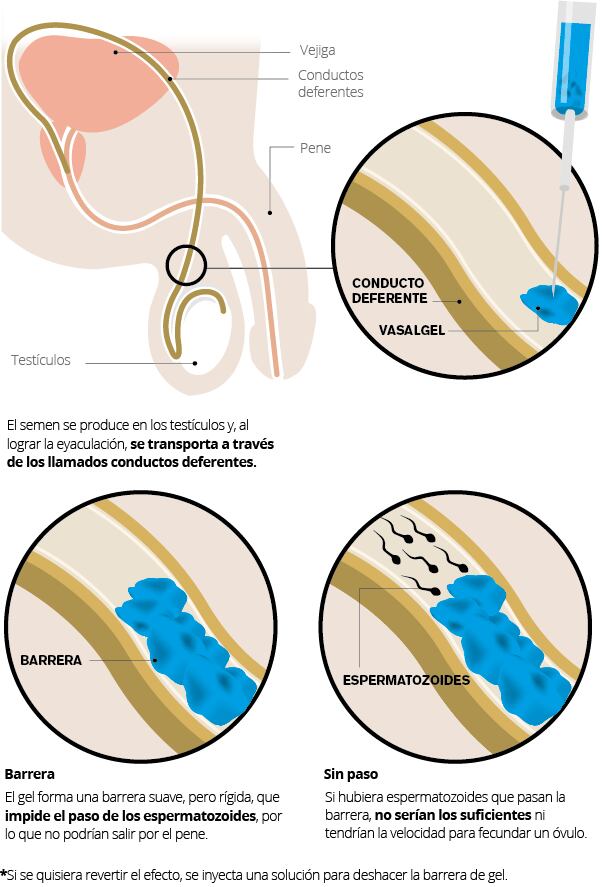 Vasalgel: qué es y cómo funciona el prototipo de anticonceptivo inyectable para hombres FUENTE: PARSEMUS FOUNDATION. || FIORELLA MORA E IRENE RODRÍGUEZ/ LA NACIÓN.