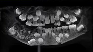 Cirugía en la India extrajo 526 dientes de la boca de un niño de siete años; conozca el insólito récord