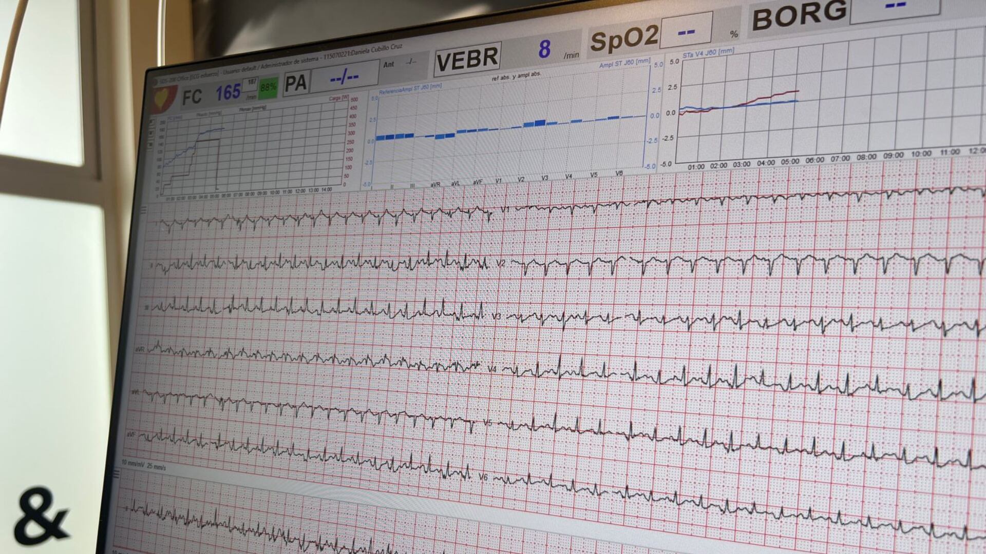 La prueba de esfuerzo detecta problemas cardiovasculares “silenciosos” que no aparecen en reposo, pero sí bajo esfuerzo.