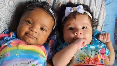 Gemelas nacen con distinto color de piel: el raro caso que explica la ciencia