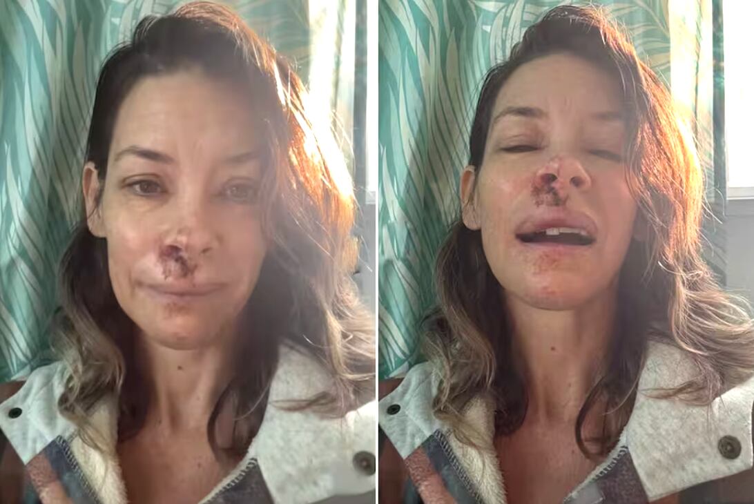 Evangeline Lilly sufrió un desmayo en la playa y cayó contra una roca. Publicó fotos con heridas visibles y un diente desplazado.