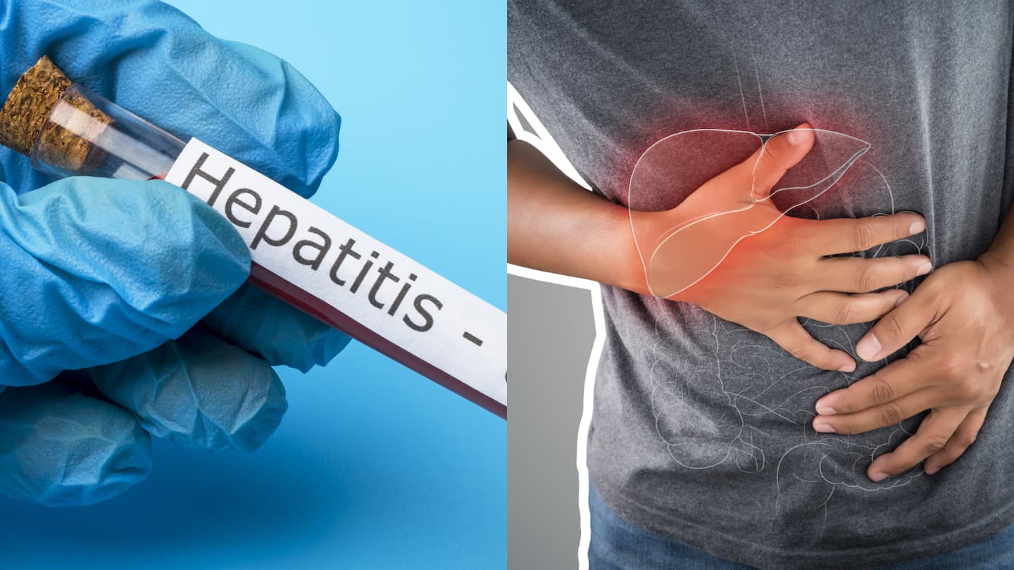 La hepatitis afecta al hígado y puede causar síntomas como ictericia, cansancio, dolor abdominal y cambios en la orina y las heces.