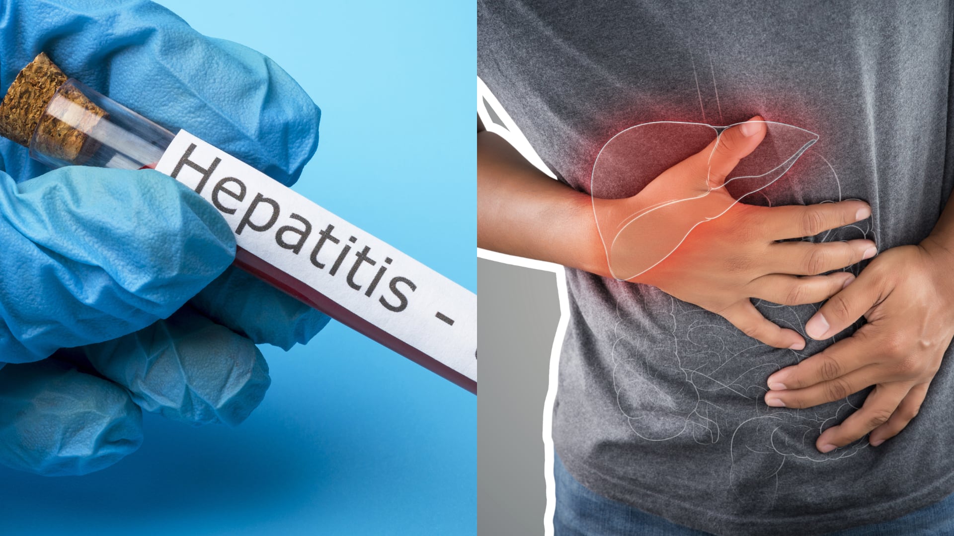 La hepatitis afecta al hígado y puede causar síntomas como ictericia, cansancio, dolor abdominal y cambios en la orina y las heces.