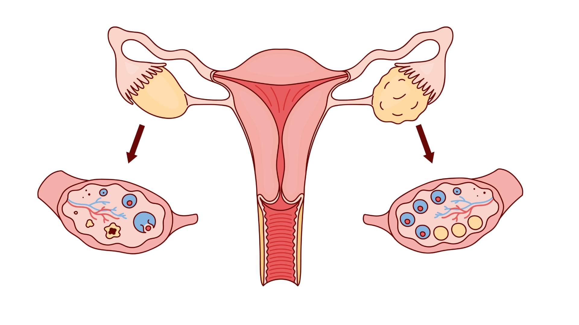En el SOPQ (a la derecha), los óvulos no maduran correctamente y el ovario produce más hormonas masculinas (andrógenos) en lugar de las hormonas femeninas (estrógenos).