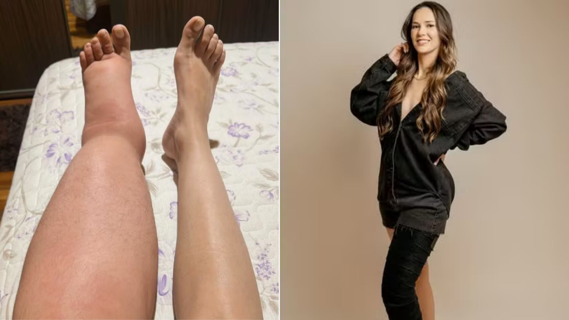 Diojane Bentas muestra el avance en el tratamiento de su linfedema, enfermedad que le fue diagnosticada tras años de búsqueda médica. A través de terapia compresiva, drenaje linfático y ejercicios, ha logrado mejorar su calidad de vida y recuperar su autoestima.