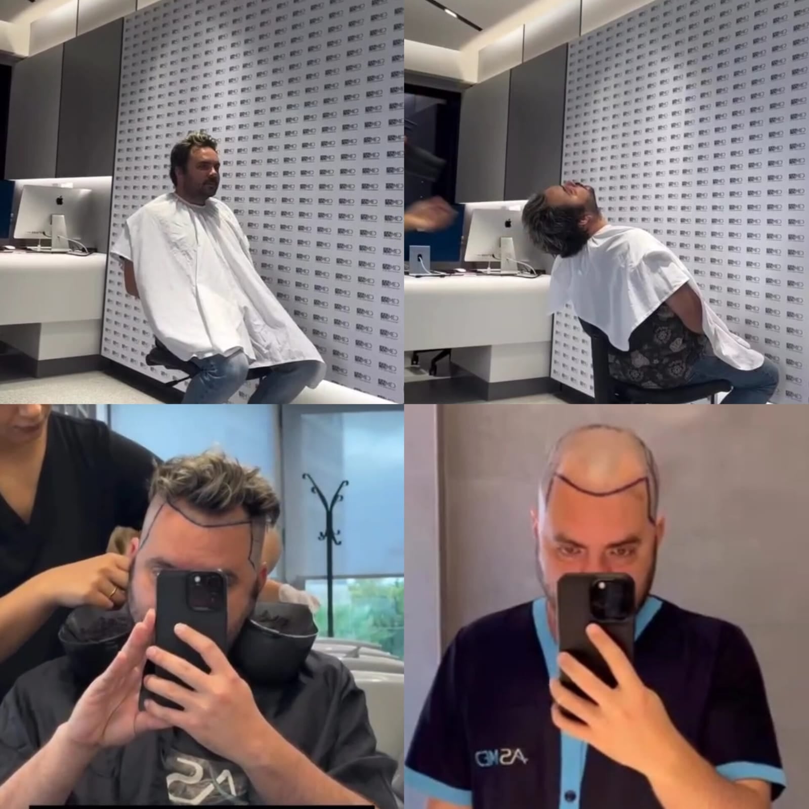 Mau Madriz implante de cabello