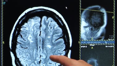 Hospitales de Costa Rica sumarán unidades para tratar derrames cerebrales, una de las principales causas de muerte