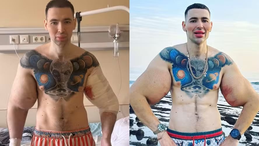 Kirill Tereshin enfrenta amputaciones tras daños por Synthol. Infección, necrosis y cirugías no han logrado frenar el deterioro en sus bíceps.