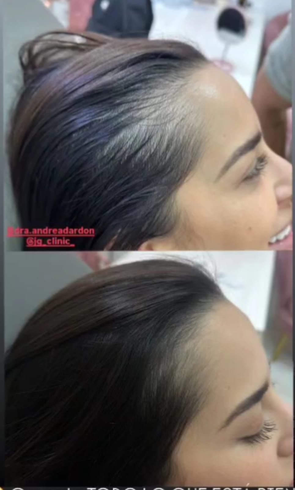 Kim Loaiza mostró cómo ha sido el proceso para tratar su alopecia.