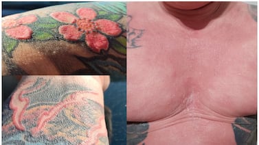 Reacción extrema a tinta roja de tatuaje provoca caída total del cabello y pérdida de sudoración en hombre europeo