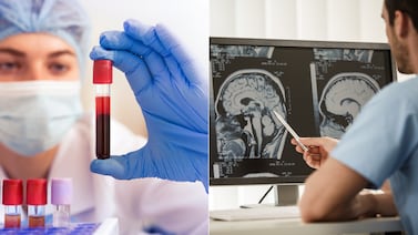 Nuevo análisis de sangre facilita la detección y el seguimiento del tumor cerebral más agresivo