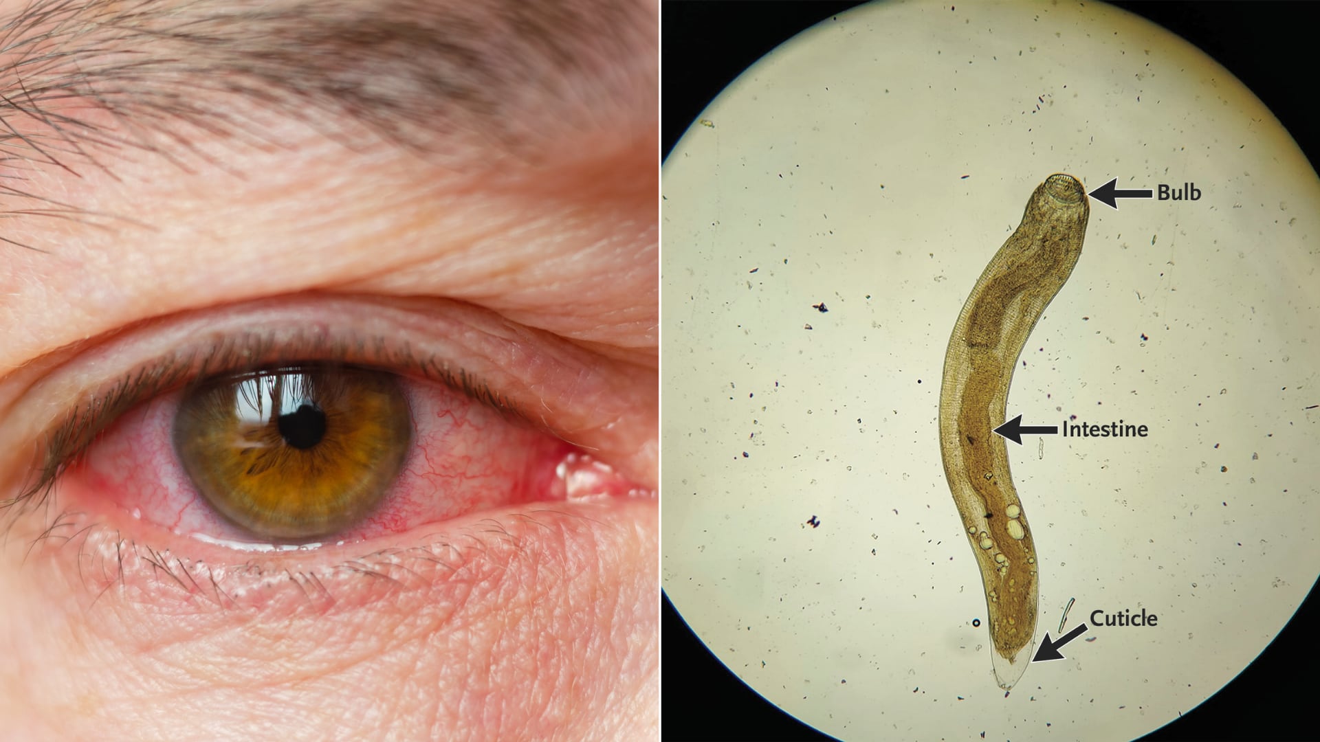 Un procedimiento quirúrgico permitió extraer al parásito alojado en el ojo, pero el paciente perdió visión por cataratas posteriores.