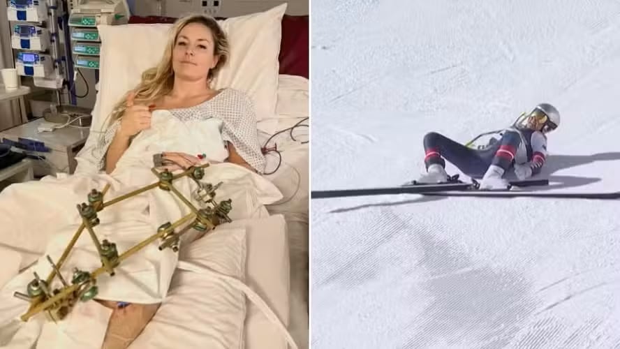 Lindsey Vonn sufrió grave fractura en la tibia izquierda. Médicos alertan sobre posible amputación y secuelas permanentes.