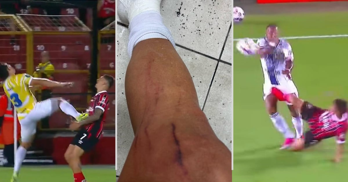 Evidentes errores de interpretación están marcando el trabajo arbitral en el Torneo de Apertura 2026 del fútbol costarricense.