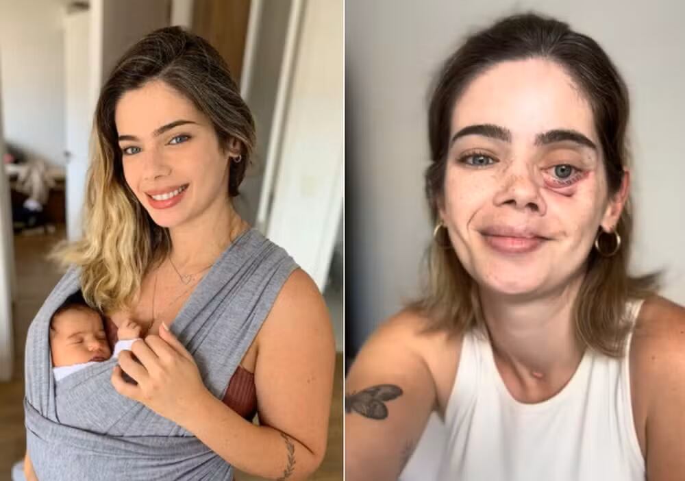 La cirujana dentista Ana Luiza Prestes, de origen brasileño, posa después de su tratamiento contra el carcinoma adenoide quístico, un tipo de cáncer raro de las glándulas salivares. Superó cirugías y radioterapia mientras cuidaba a su hija pequeña.