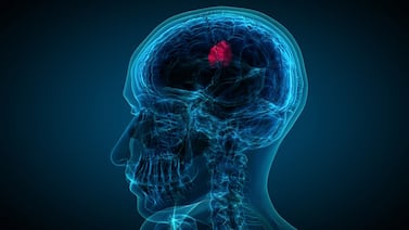 Seis síntomas poco conocidos que podrían alertar sobre un tumor cerebral