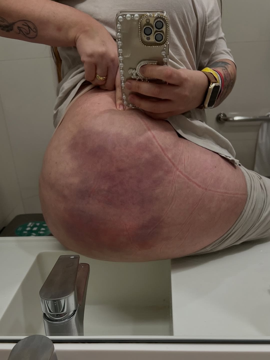 Natália Teixeira enfrenta secuelas severas tras bioplastia glútea. Caso expone riesgos y avanza en proceso judicial contra clínica.