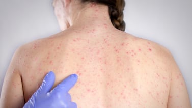 Sarampión en Costa Rica: qué tan protegido está usted y por qué preocupa tanto este virus