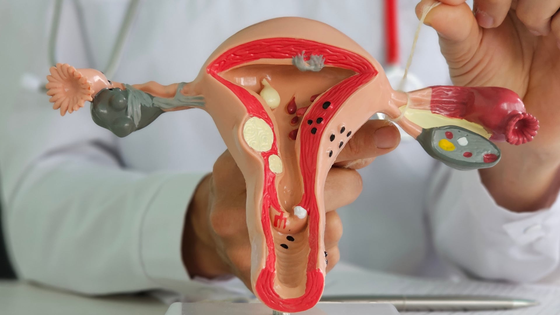 El síndrome de ovario poliquístico ahora se llama síndrome ovárico metabólico poliendocrino (SOMP), reconociendo que no es solo un problema reproductivo sino una enfermedad sistémica.