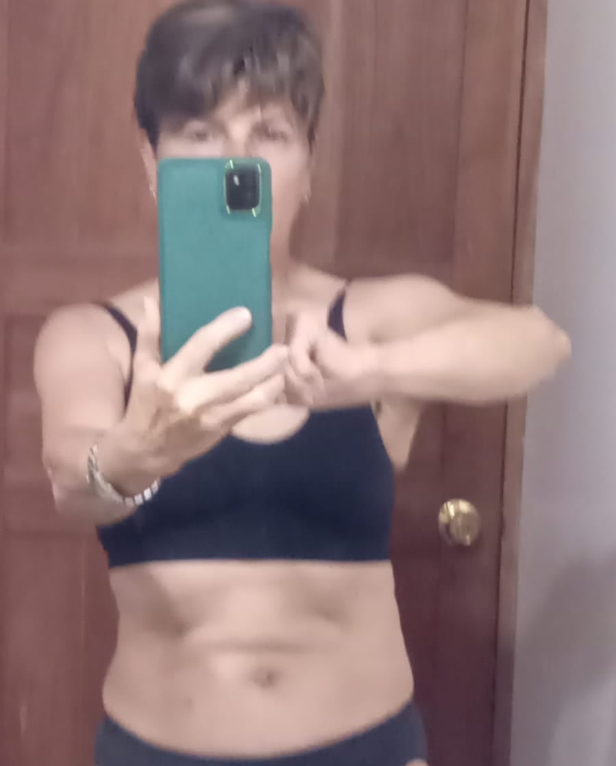 Este era el estado de Gabriela Rossi antes de la liposucción.