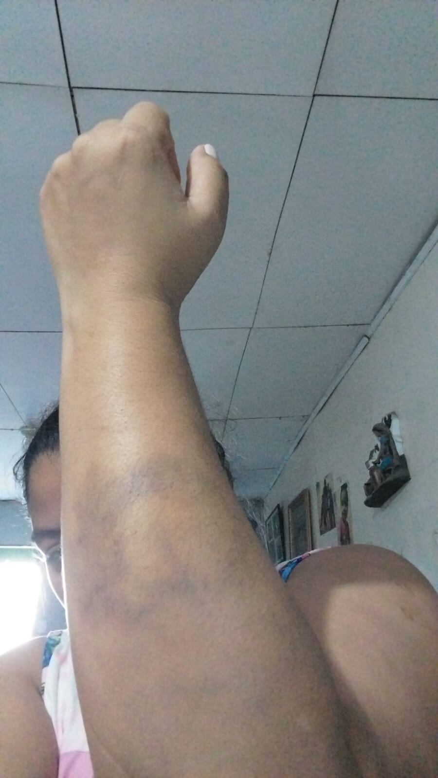 Según la valoración que le hicieron en el INS, el mordisco que le dio un estudiante de primer grado a la docente Jimena Gómez Sosa, provocó el desgarro de un músculo de sus brazo izquierdo.