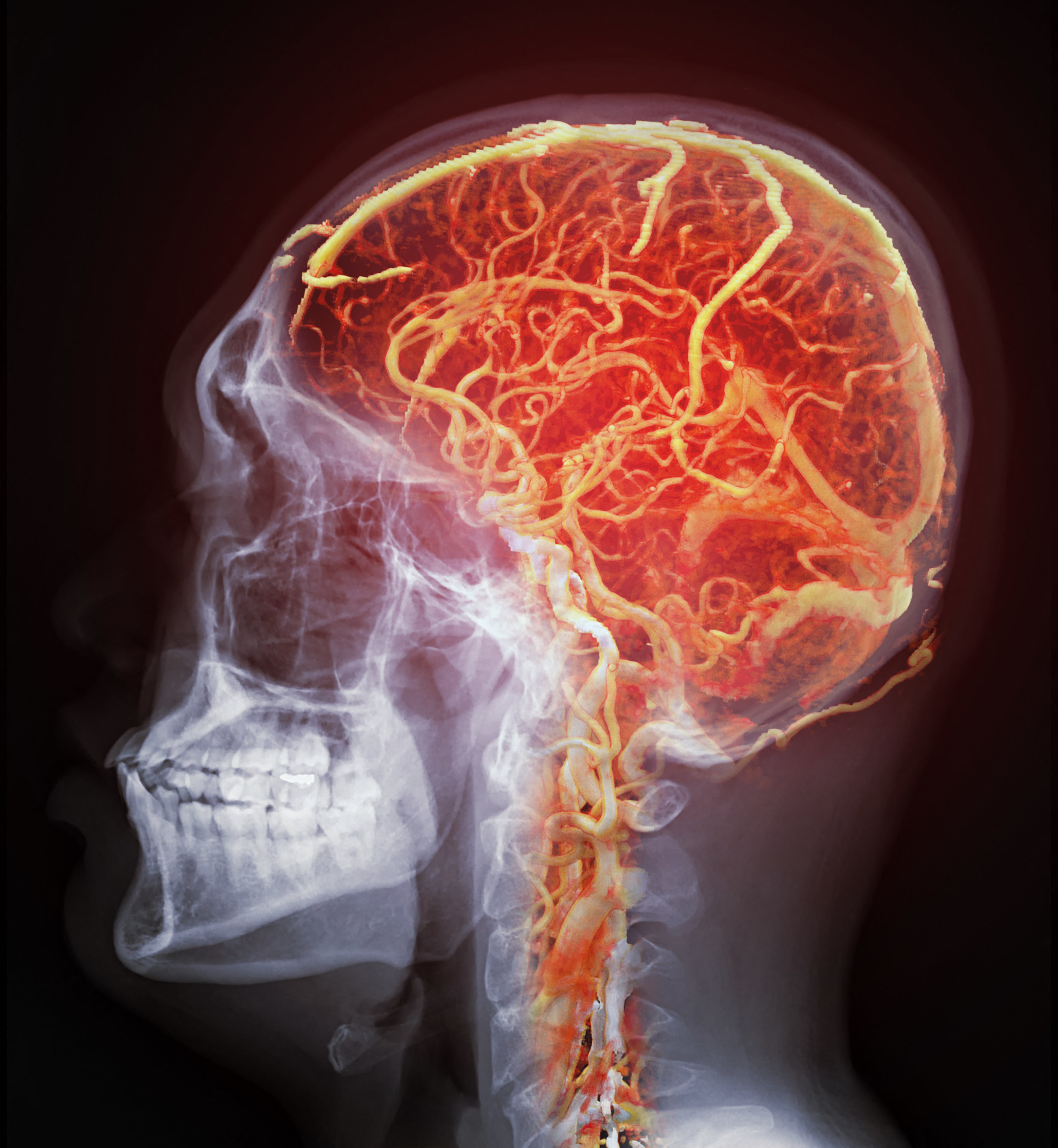 Coloured computed tomography angiograph (CTA) of healthy cerebral arteries, with an overlay of the skull. (Photo by SAMUNELLA/SCIENCE PHOTO LIBRARY / SPD / Science Photo Library via AFP)Coloured computed tomography angiograph (CTA) of healthy cerebral arteries, with an overlay of the skull. (Photo by SAMUNELLA/SCIENCE PHOTO LIBRARY / SPD / Science Photo Library via AFP)