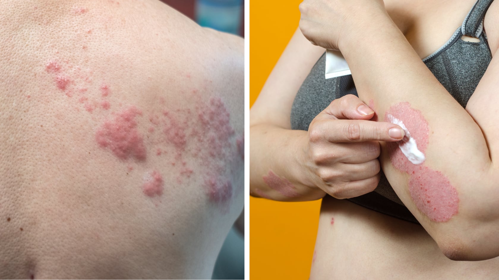 Chile logró eliminar la lepra y recibió la verificación oficial de la OMS tras mantener más de 30 años sin transmisión local.