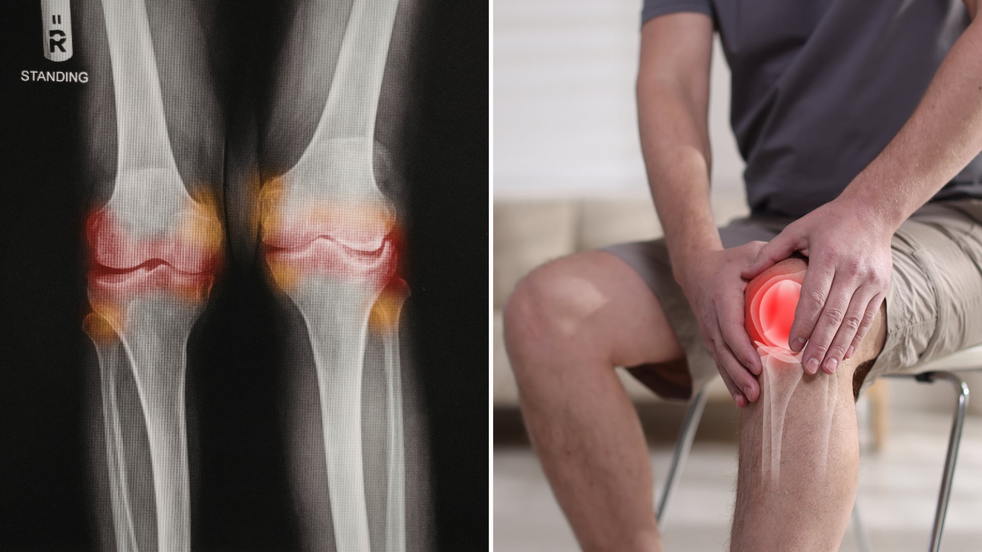 Científicos prueban una inyección que regenera cartílago en animales y podría cambiar el tratamiento de la osteoartritis.