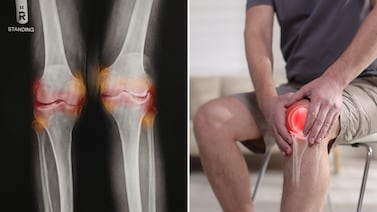 Inyección experimental logra regenerar cartílago en semanas y abre nueva vía contra la osteoartritis