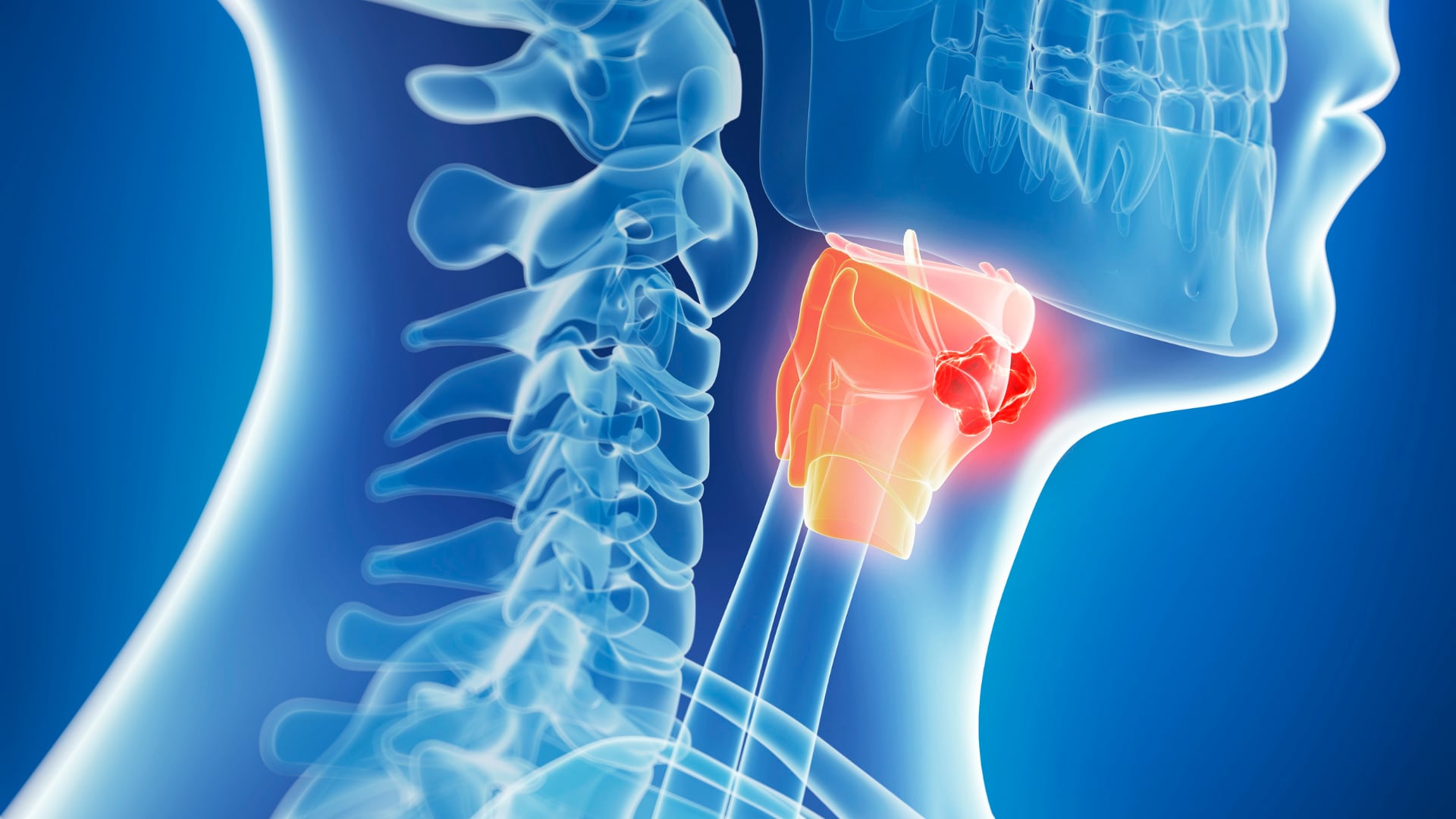La ubicación del tumor influye en los síntomas. Puede aparecer en la boca, la garganta, la lengua, la laringe, las amígdalas, la cavidad nasal o las glándulas salivales.