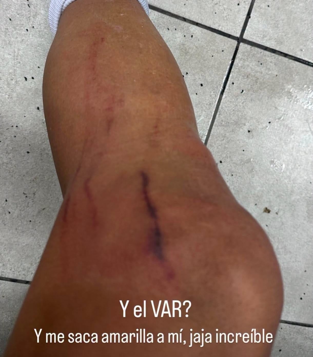 Nestor Monge mostró como quedó su pierna después del partido contra Sporting