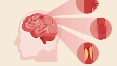 ¿Cómo detectar y actuar rápido ante un accidente cerebrovascular?