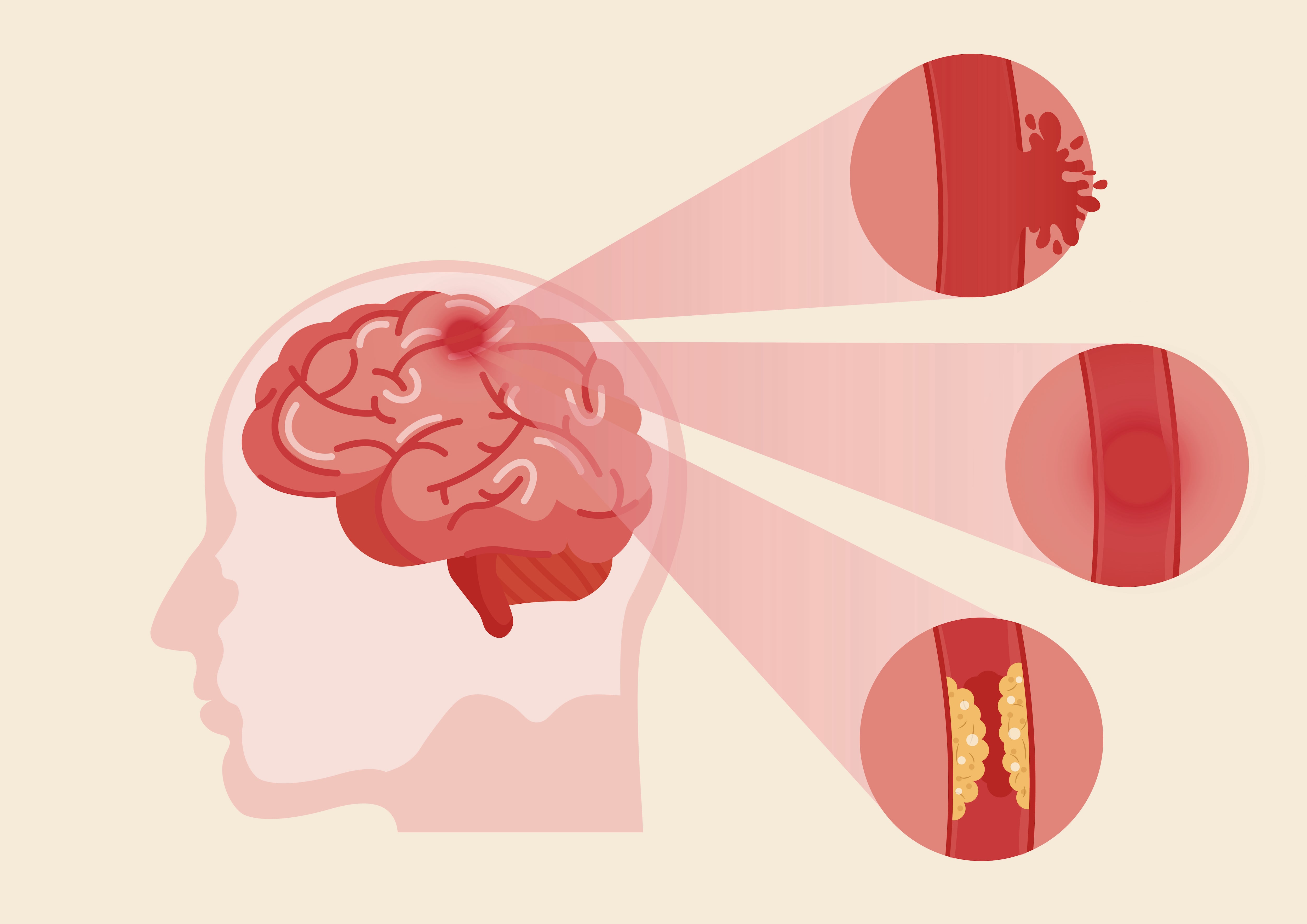 Esta ilustración presenta los diferentes tipos de accidentes cerebrovasculares.
Ilustración: Shutterstock