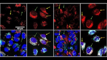 Científicos logran eliminar el 70% de células cancerosas in vitro mediante una potente combinación trimodal