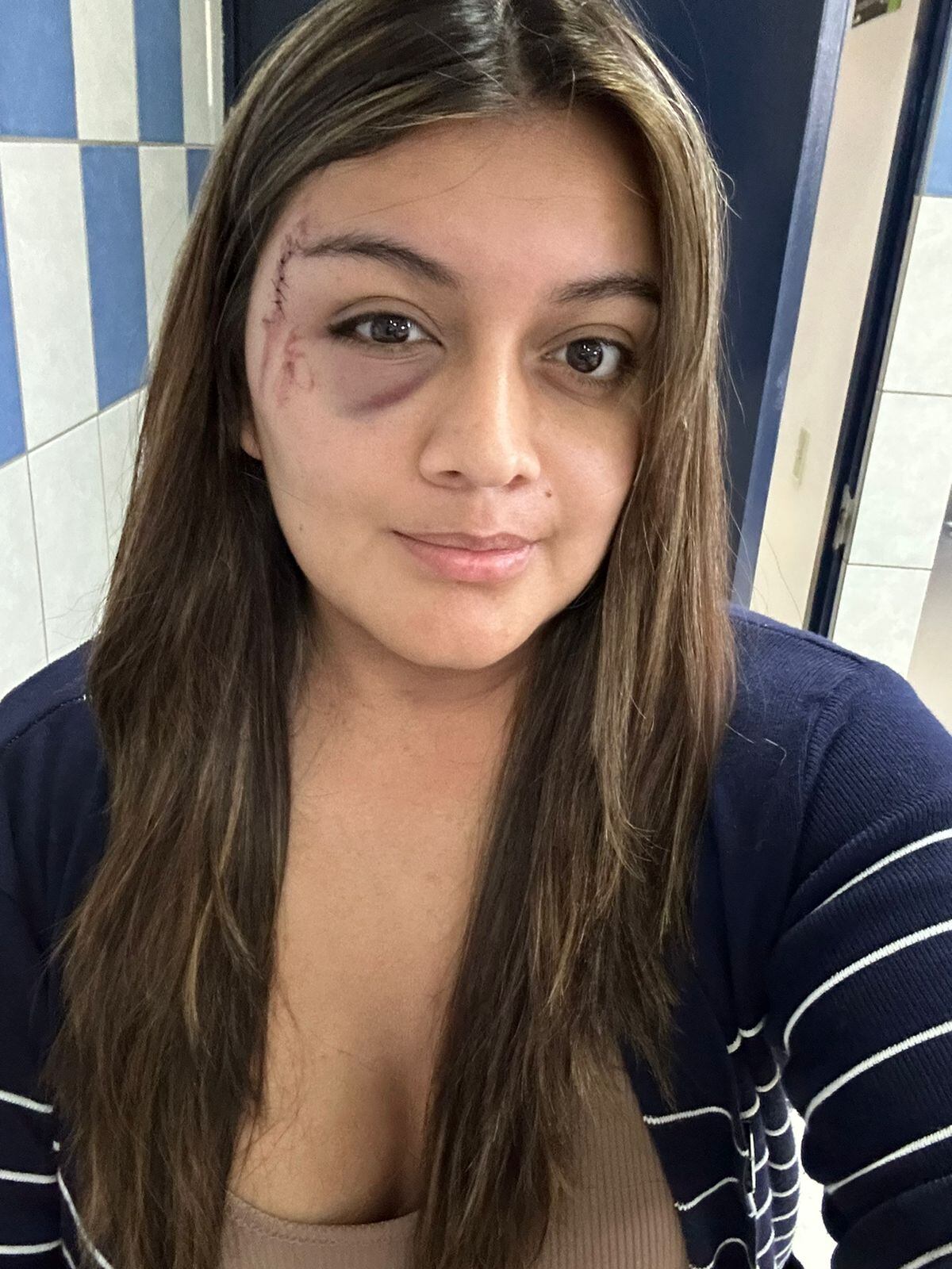 La conductora, Andrea Azofeifa, fue la única que no quedó internada. Además de los golpes en la cara y cuello, tiene 56 puntadas en el brazo derecho. Foto: Cortesía Andrea Azofeifa.