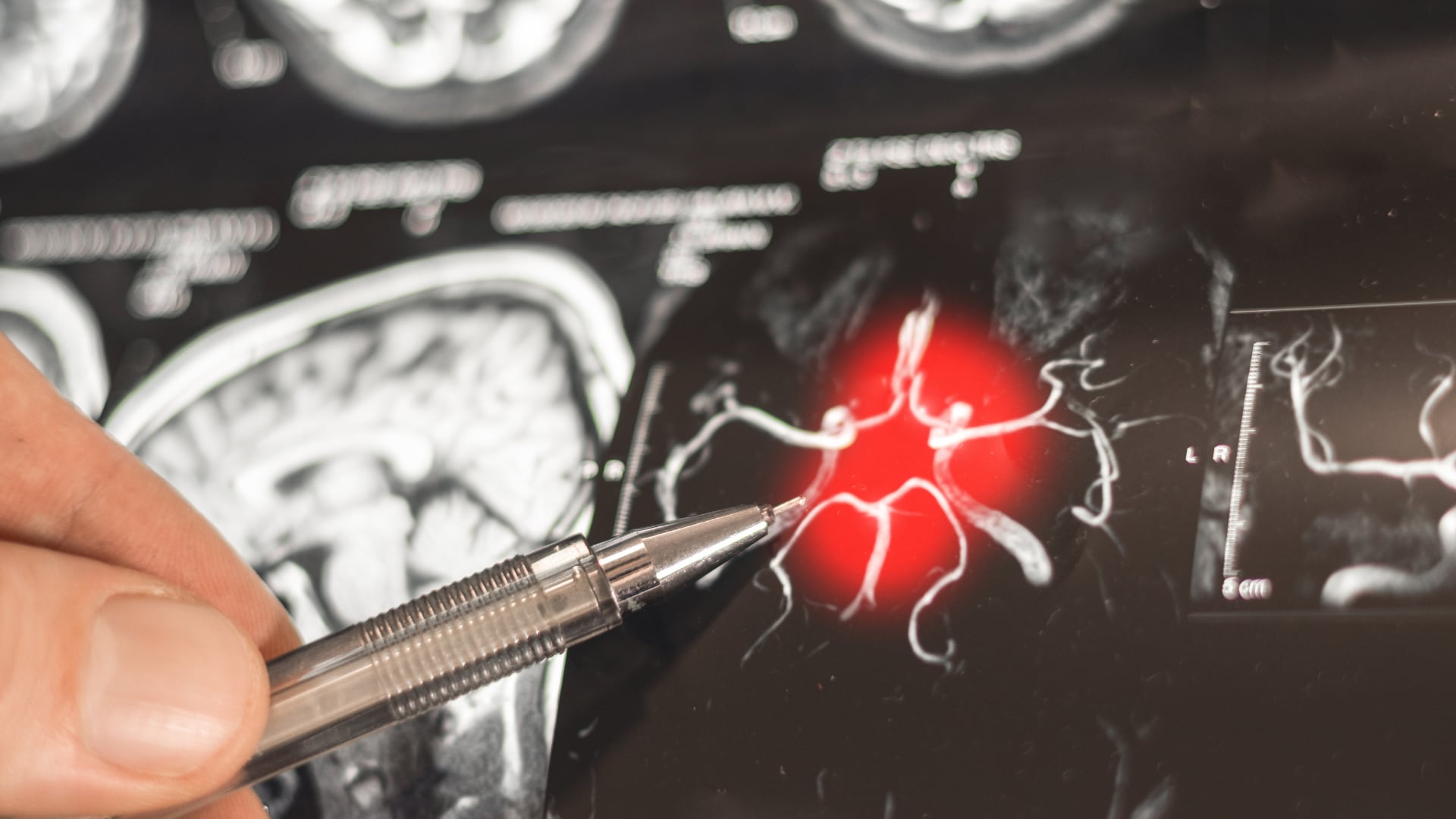 La epilepsia puede aparecer a cualquier edad y no siempre se detecta de inmediato.