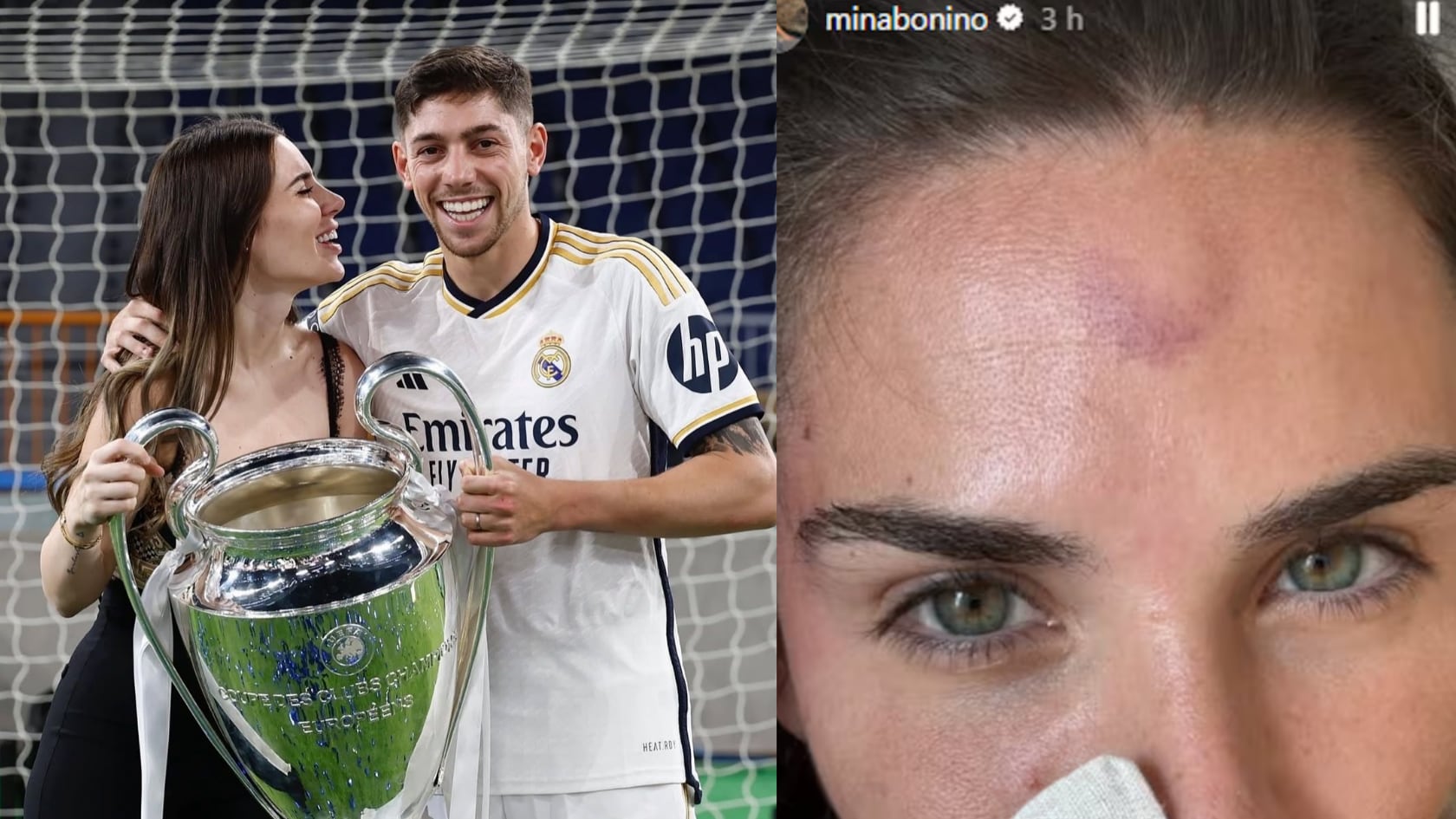 Una compra en Temu dejó a Mina Bonino con un inesperado moretón en la frente durante la ola de calor europea.