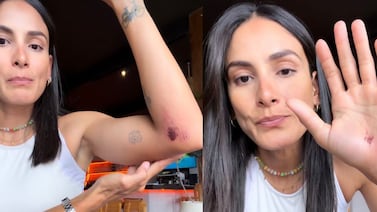 Johanna Solano confirma fractura en una mano y queda fuera de La Ruta de los Conquistadores