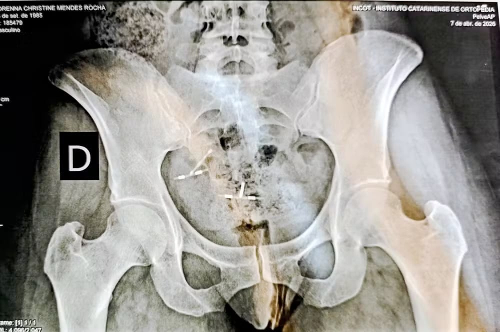 Lorenna Rocha enfrentó meses de dolor y una compleja cirugía luego de que un DIU se desplazó hacia el abdomen sin ser detectado.