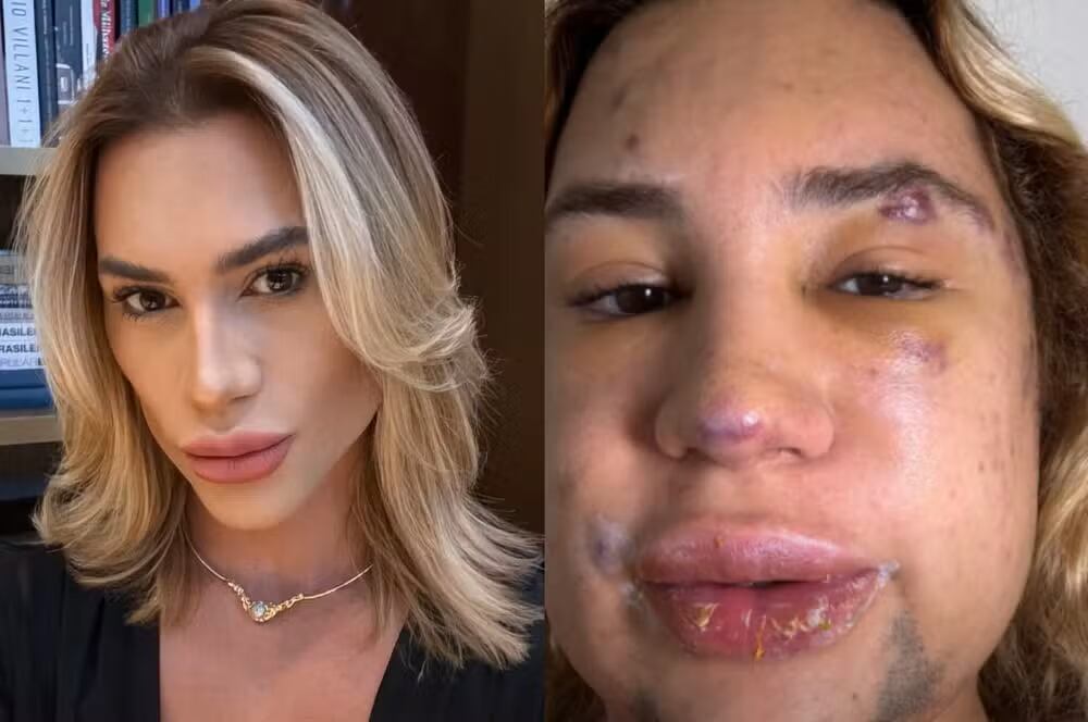 Procedimientos estéticos realizados por no médicos generan secuelas graves y aumentan la demanda de atención médica especializada