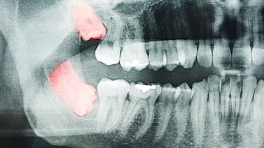 Las muelas cordales están en peligro de desaparición