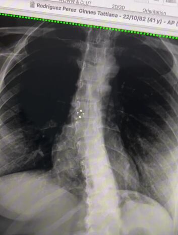 Ginnés Rodríguez tiene escoliosis