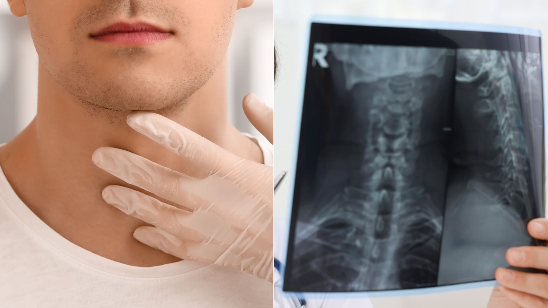 Un tratamiento con radiofrecuencia en el nervio frénico eliminó un caso extremo de hipo crónico que afectó a un paciente durante dos décadas.