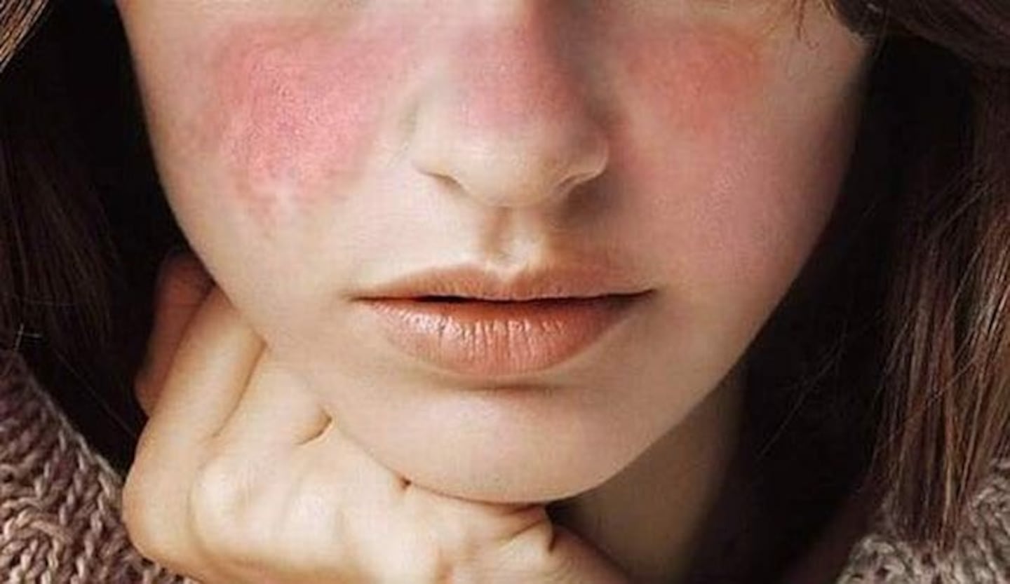 ¿Qué es el lupus y cómo afecta la vida diaria? | La Nación