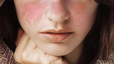 ¿Qué es el lupus y cómo afecta la vida diaria?