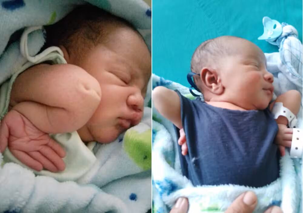 João Pedro nació con los codos hacia arriba por una malformación. Su tratamiento sin cirugía ha mostrado notables progresos.