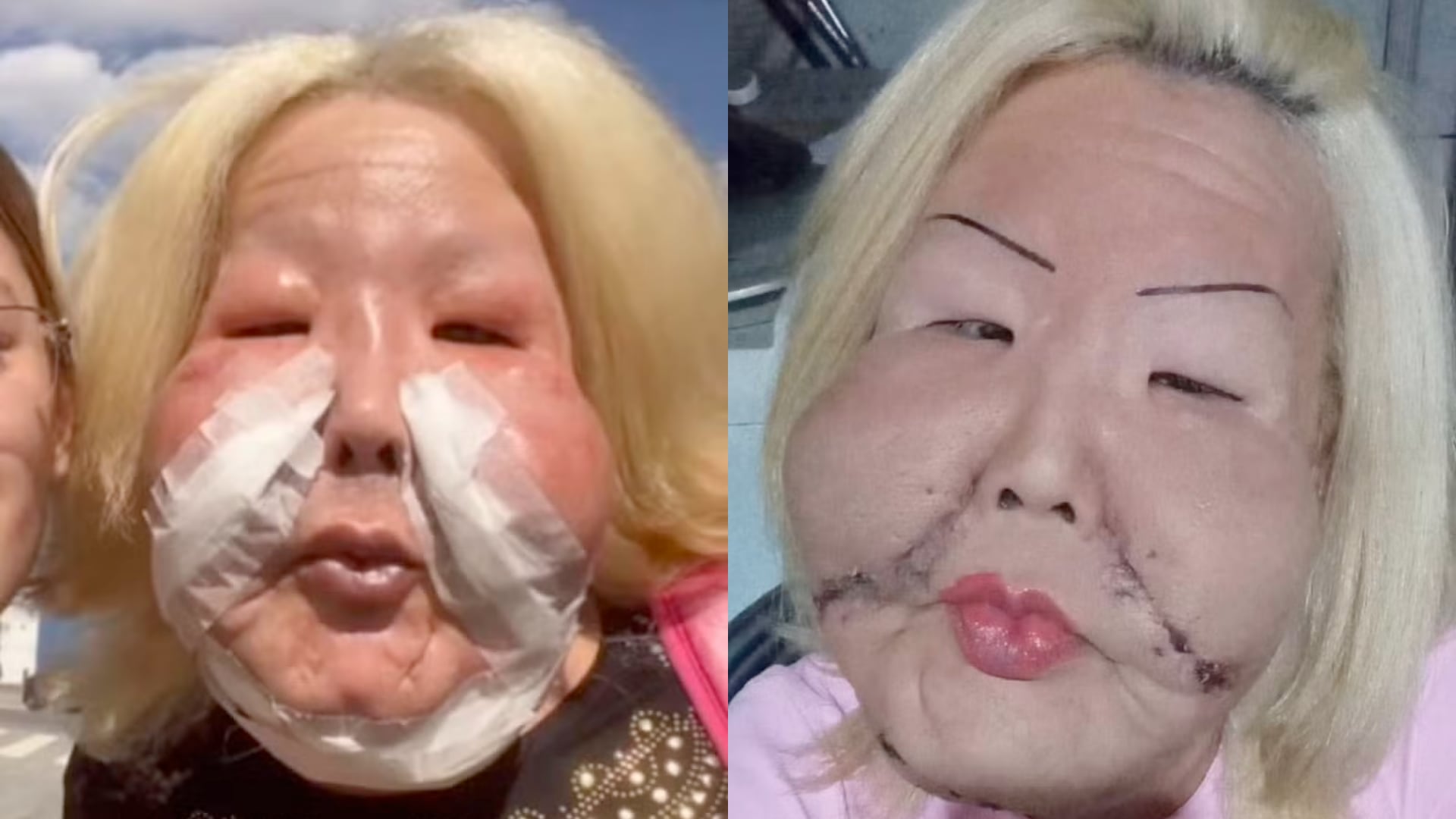 Juju do Pix reveló el estado de su rostro tras cirugía para eliminar aceite industrial aplicado en 2017; planea una segunda intervención.